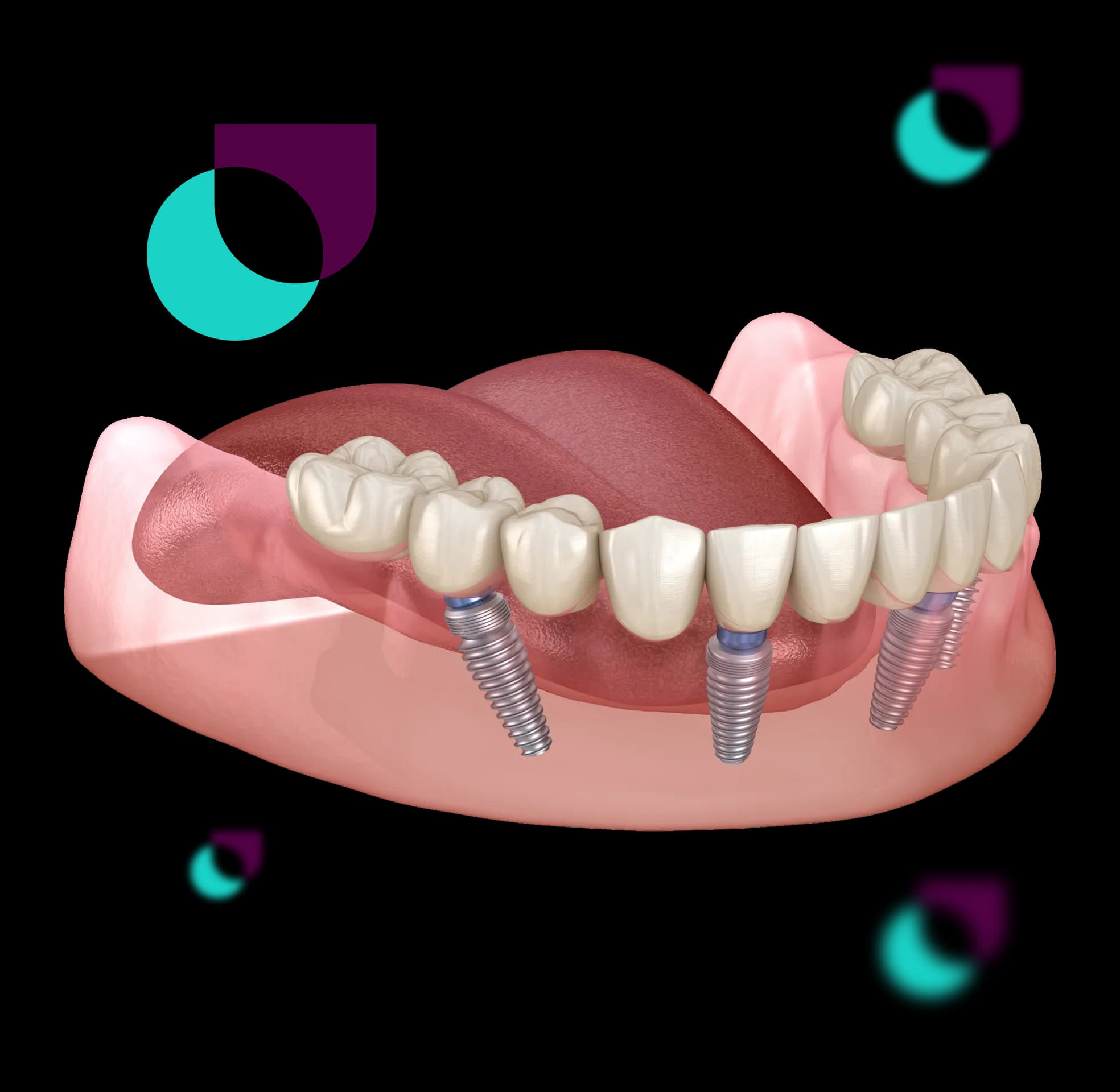 Tecnologia digital de implantes Oral Unic